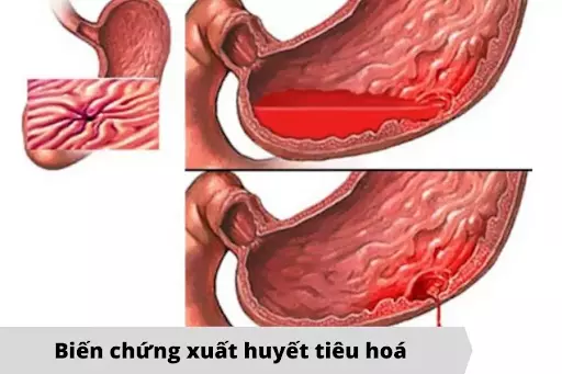 bien-chung-xuat-huyet-tieu-hoa-do-xo-gan-gay-ra.webp